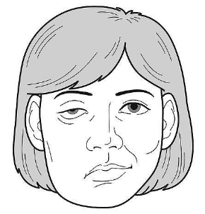 顔面神経麻痺.jpg