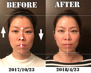 BeforeAftereye2-300x242.png