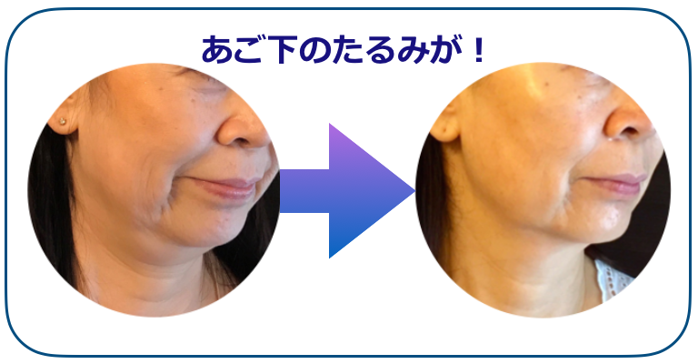 あご下のたるみBEFOREAfTER.png