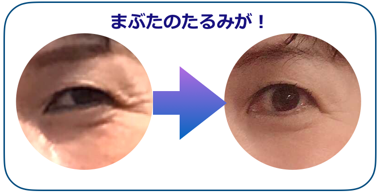 まぶたのたるみBEFOREAfTER.png