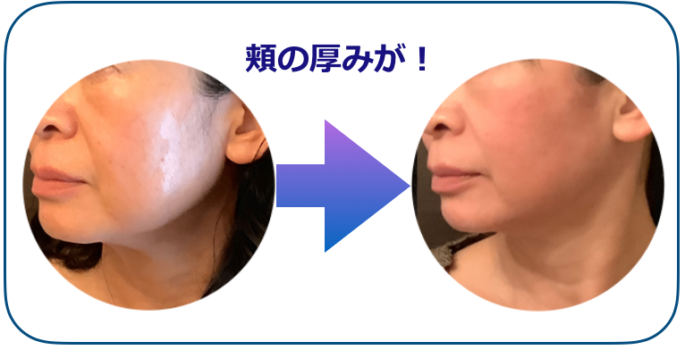 頬の厚みBEFOREAfTER.png