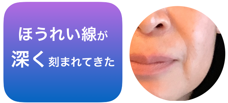 ほうれい線の悩み.png