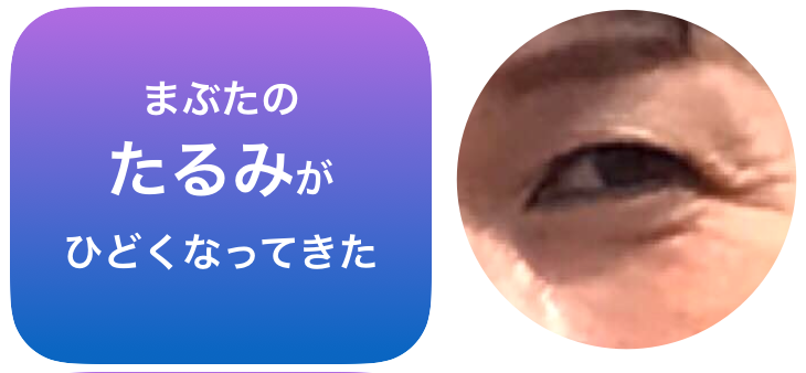 まぶたのたるみ悩み.png