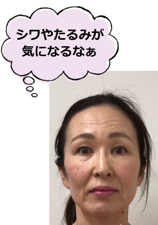 嶋崎明美さんシワの悩み.png