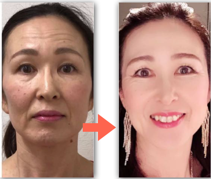 嶋崎明美さんBeforeAfter2.png