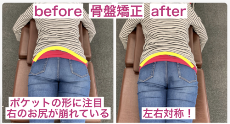 骨盤矯正.png