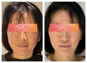 老化で顔は 3センチも長くなる エクセレントラインプログラム