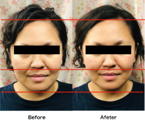 ホリ深くなりたい という方必見 15秒自力整形