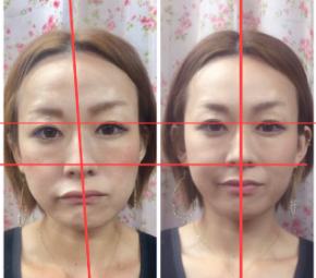 ホリ深くなりたい という方必見 15秒自力整形